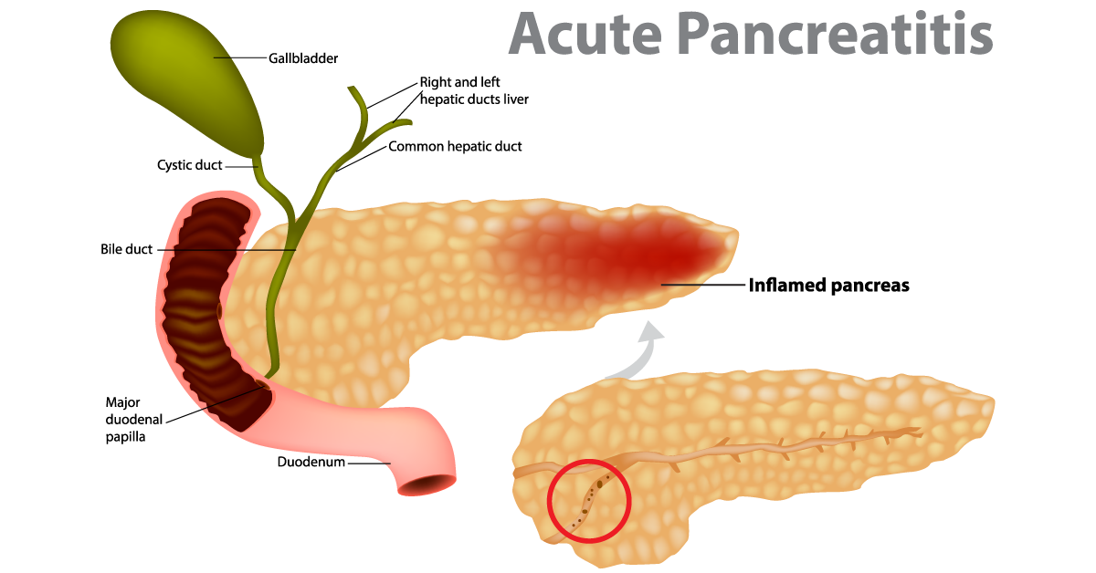 Acute Pancreatitis caused by gallstone