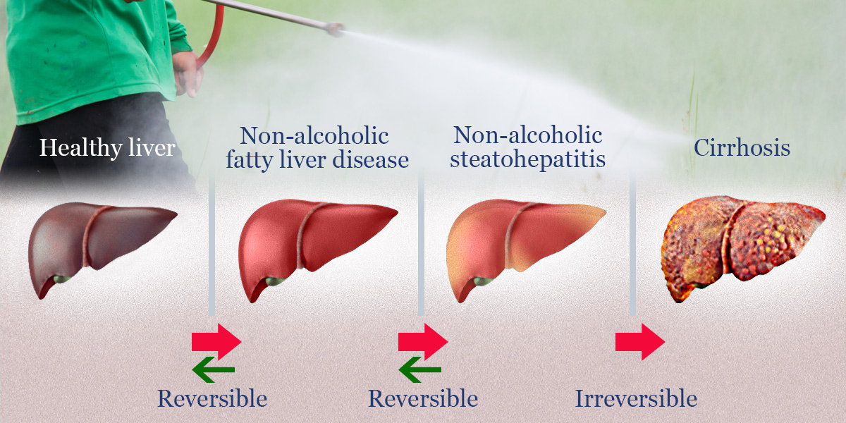 Fatty Liver disease and glyphosate