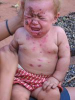 Baby with sores